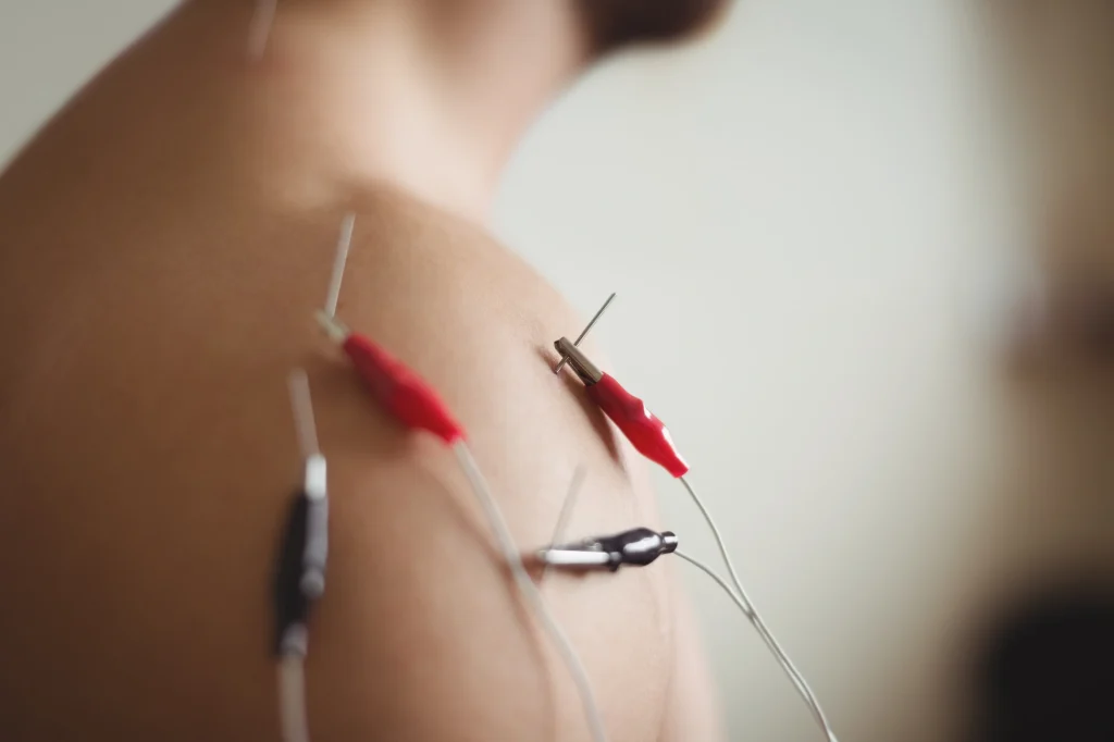 Agujas de fisioterapia conectadas a electroestimulación en el hombro de un paciente